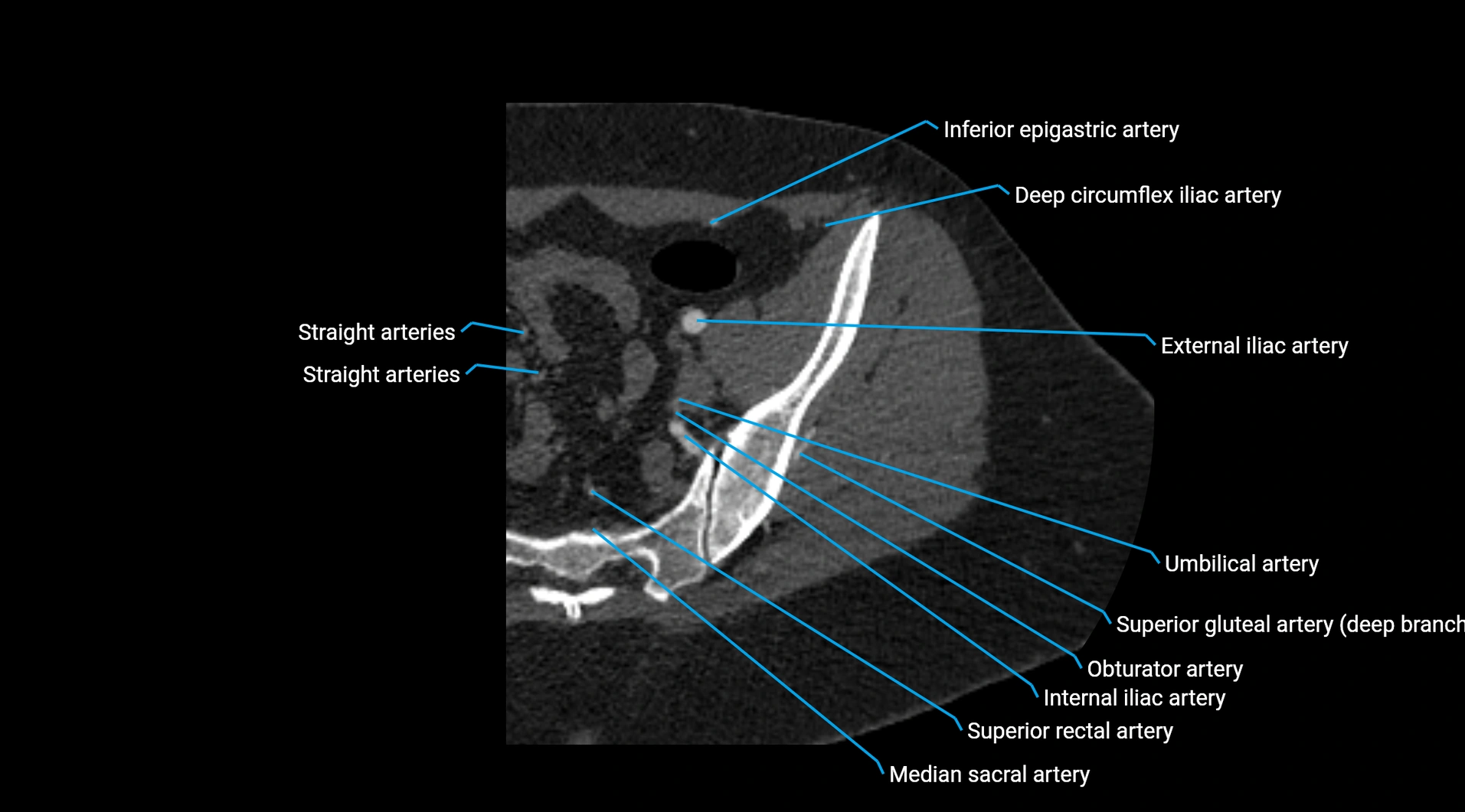 CTA lower limb cross sectional anatomy labelled image _31.webp